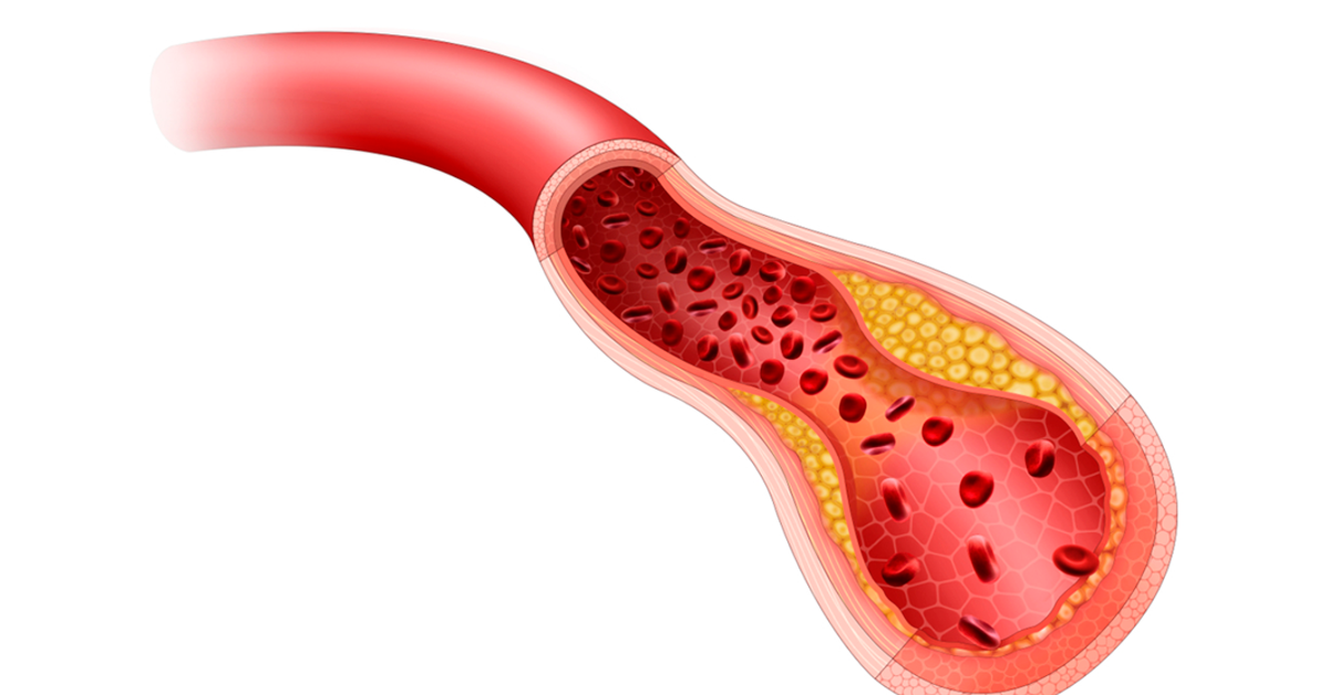 Obstrucao de carotidas